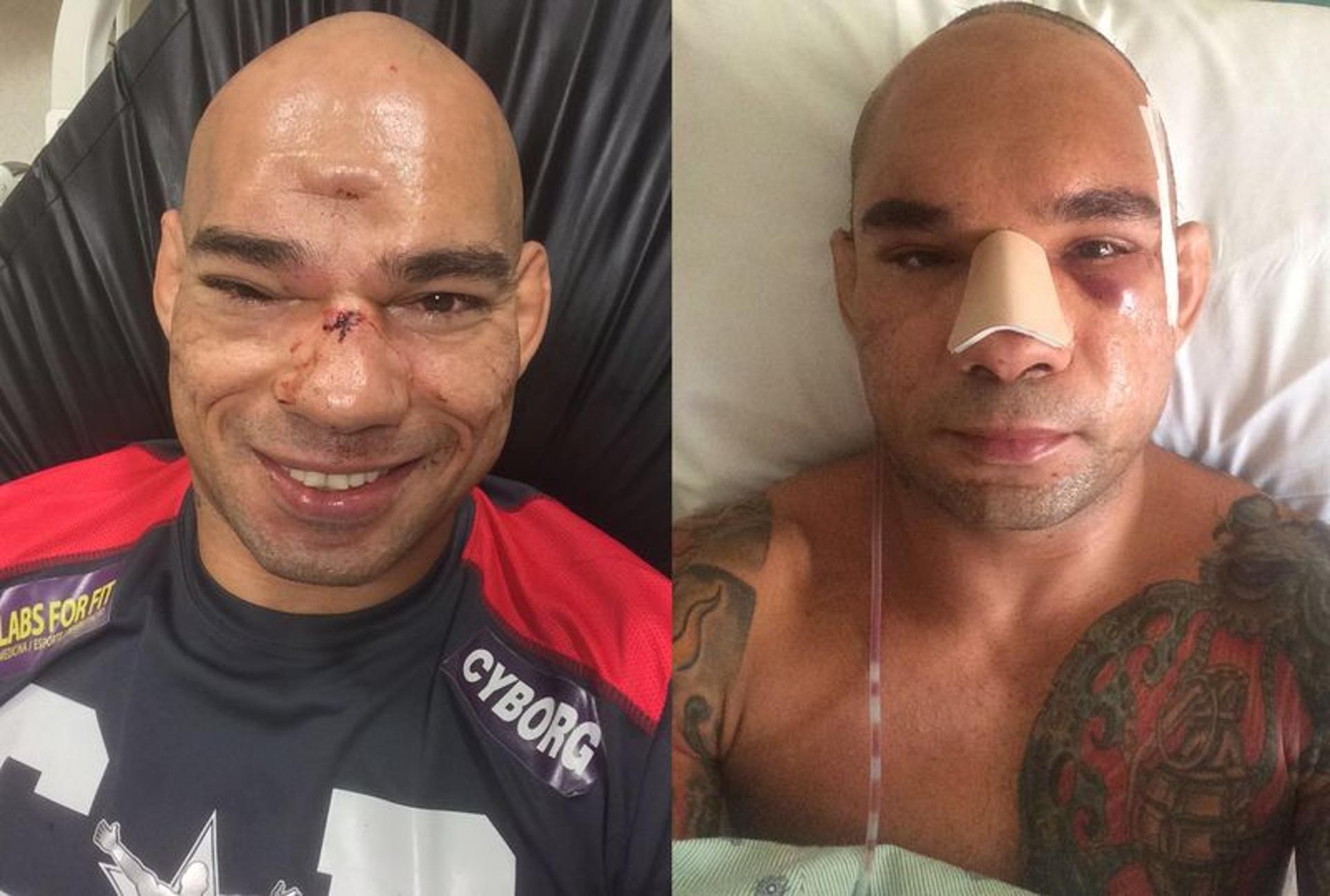 Evangelista Cyborg antes e depois da cirurgia na face