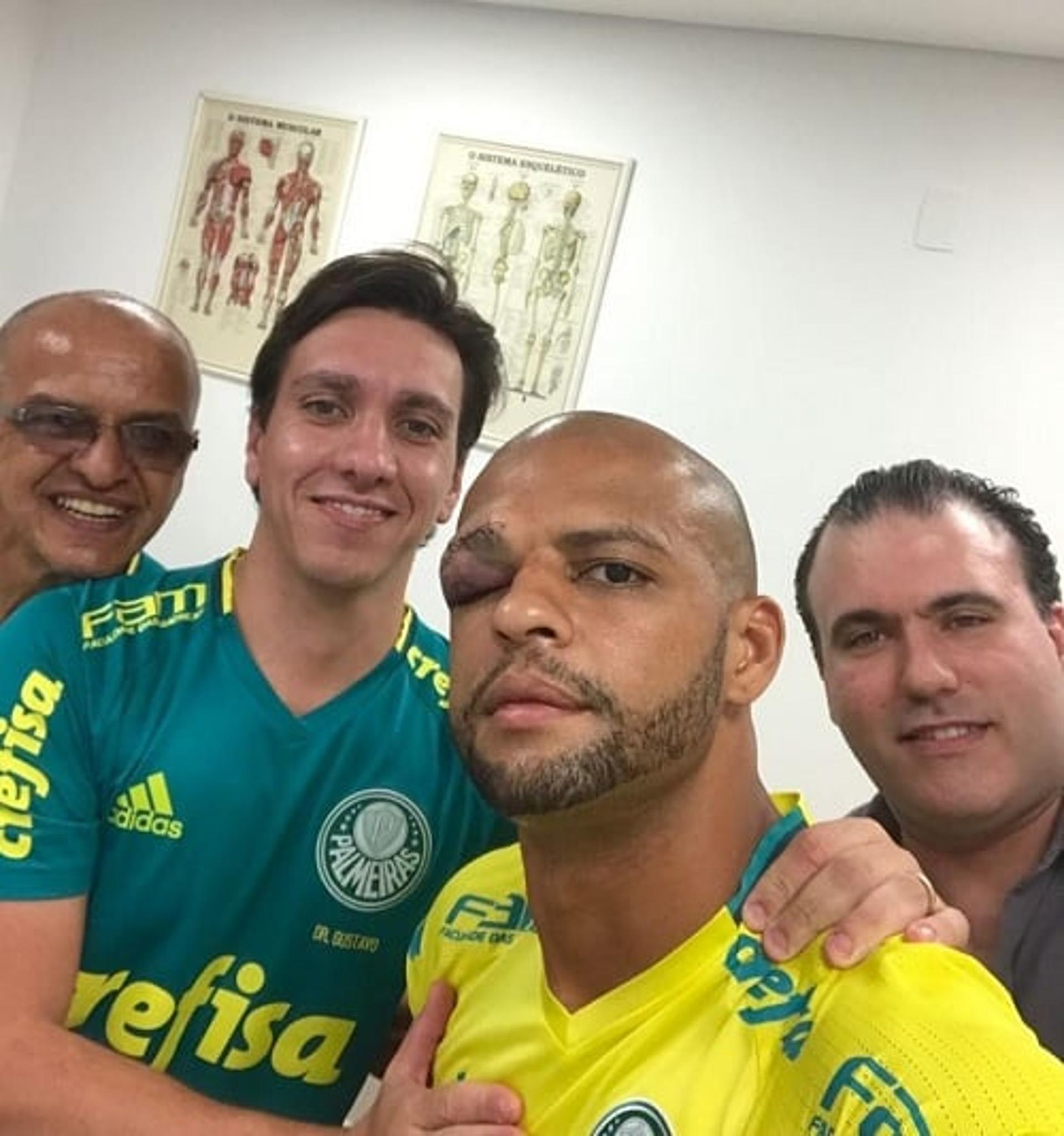 Felipe Melo posta foto com o supercílio bastante inchado