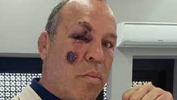 Wanderlei Silva sofreu escoriações e quebrou o osso do pé após ser atropelado (Foto: Arquivo Pessoal)