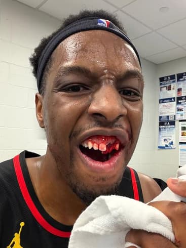 Onyeka Okongwu com os dentes quebrados após jogo da NBA (Foto: Reprodução/Instagram)