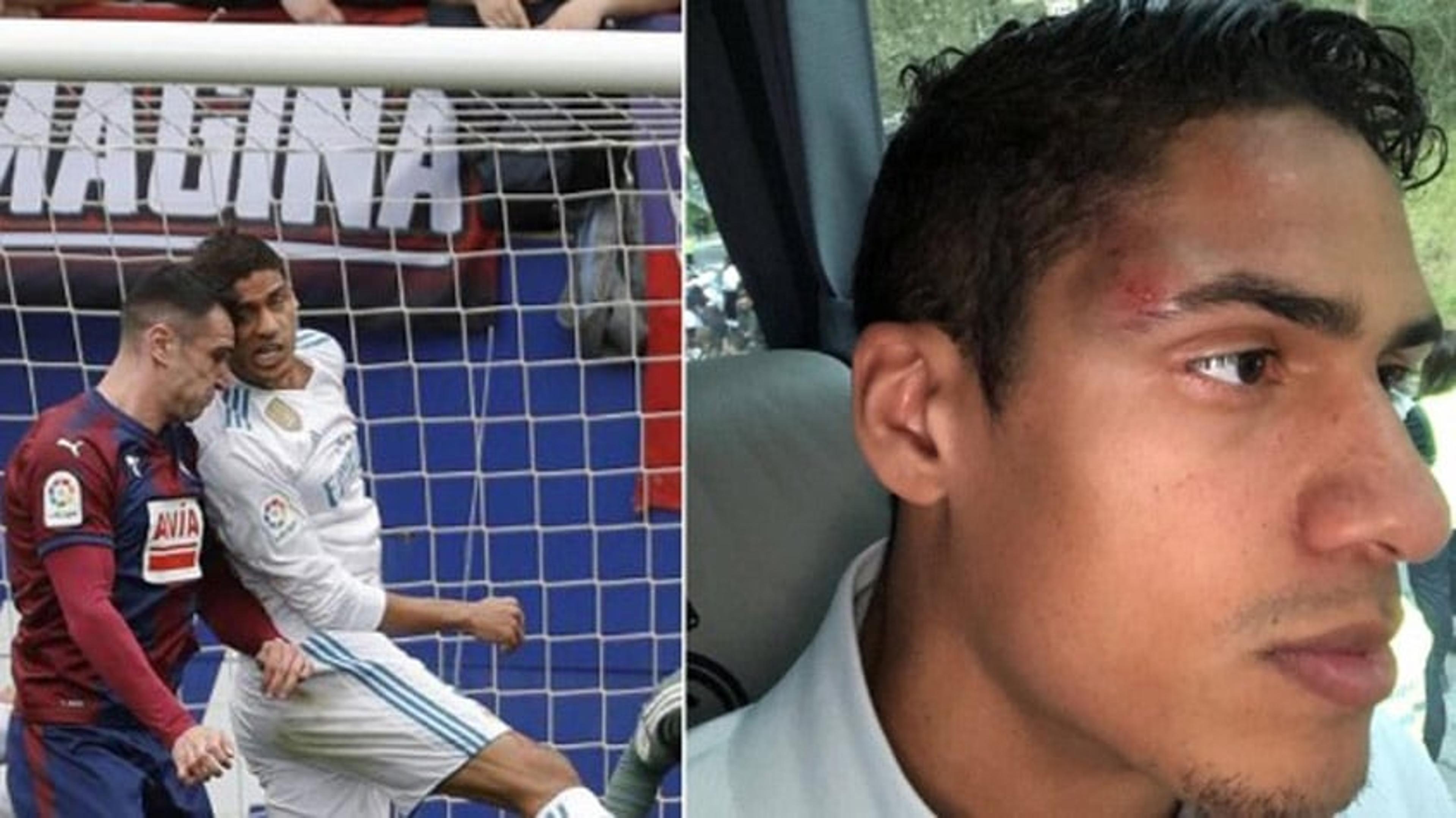 Varane exibe hematoma no rosto após choque com jogador do Eibar