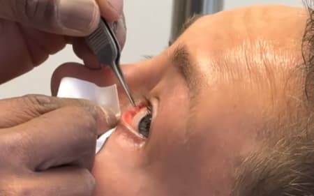 Lutadora americana Rose Namajunas retira tubo do olho esquerdo (Reprodução)