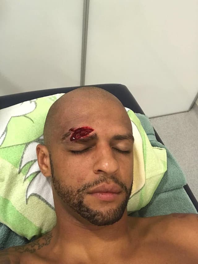 Felipe Melo ficou com grande corte no supercílio após o Dérbi