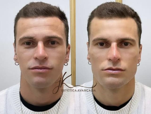 Antes e depois - Lucas Lima harmonizado