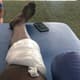 Sassá - Tratamento de lesão no joelho