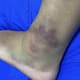 Pamela Rosa posta foto do tornozelo contundido