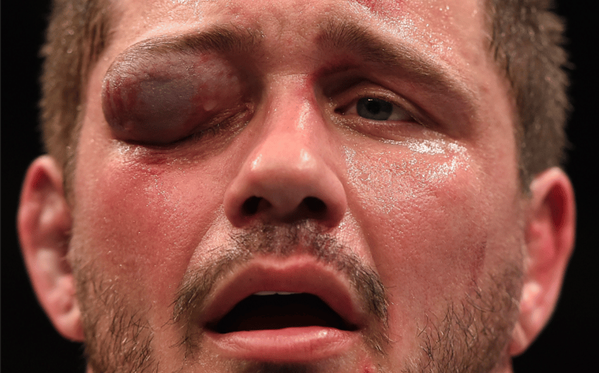 Matt Mitrione acaba luta com inchaço no olho direito (FOTO: UFC)