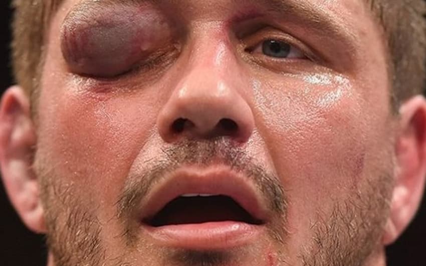 Matt Mitrione ficou com o olho inchado após derrota contra Travis Browne no UFC