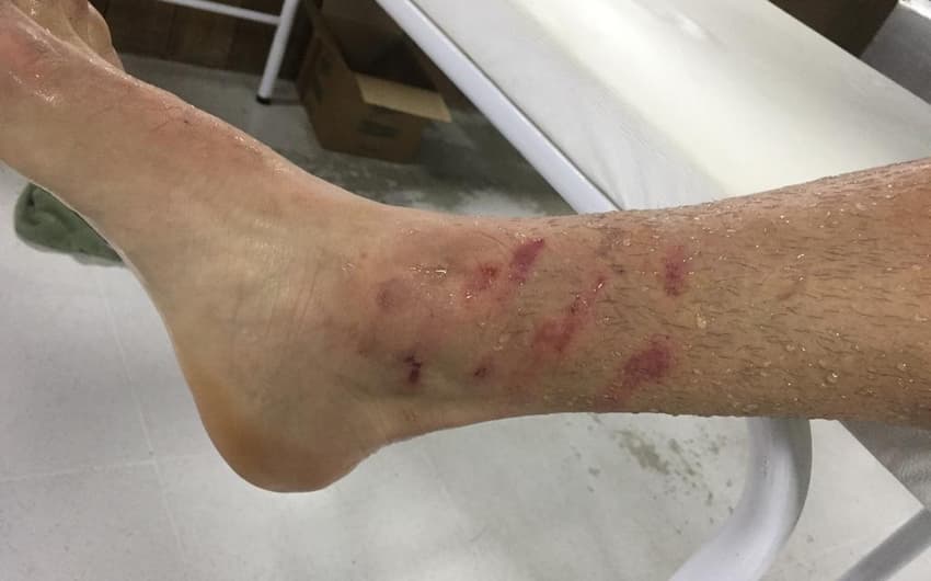 Travas da chuteira de Bruno Guimarães marcaram o tornozelo de Gustavo Gómez