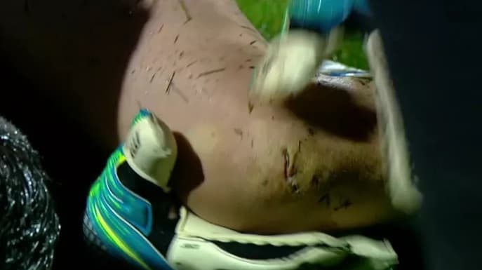 Marcelo Grohe precisou levar sete pontos após dividida com zagueiro do Godoy Cruz