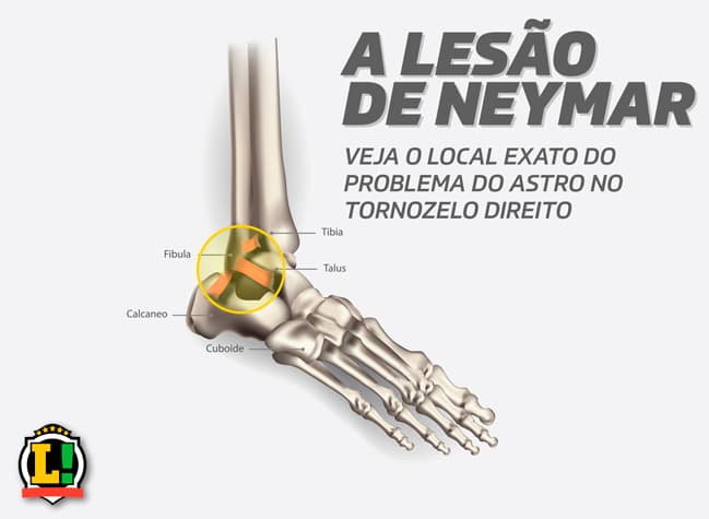 Infográfico - Lesão neymar