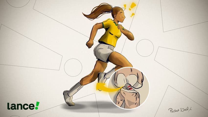 Lesão de Ligamento Cruzado Anterior (LCA). (Ilustração: Pedro Leal)
