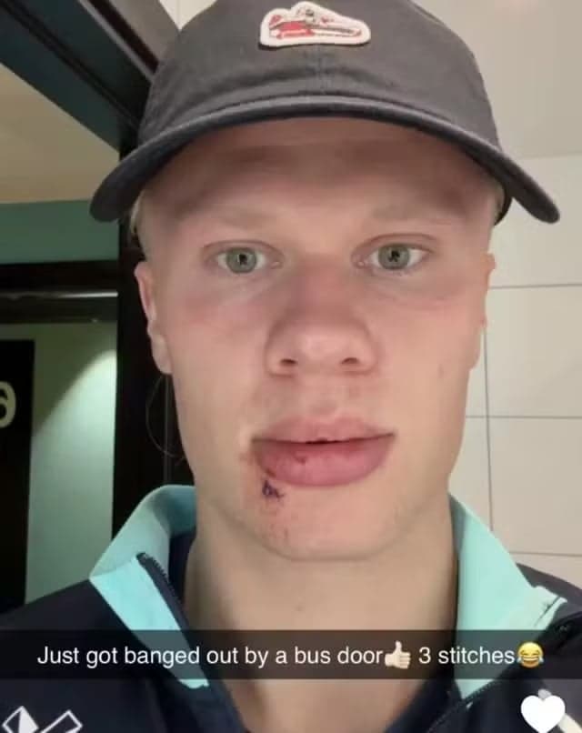Haaland posta foto de lesão inusitada (Foto: Reprodução/Snapchat)