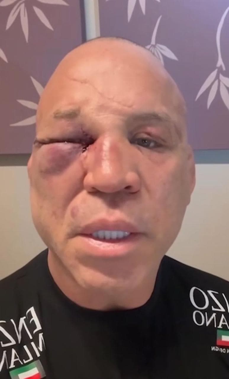 Waderlei Silva após briga no Spate Fight (Foto: Reprodução Instagram)