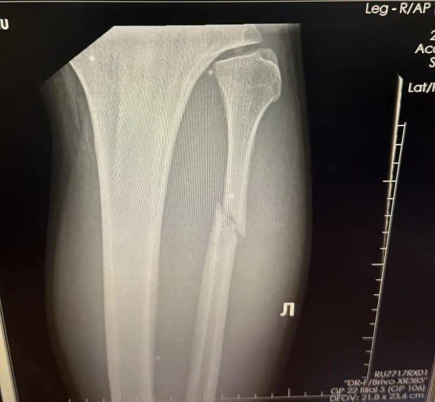 Raio-x de lesão de Valter Walker no UFC 321 (Foto: Reprodução/Instagram: @valterwalkerufc)