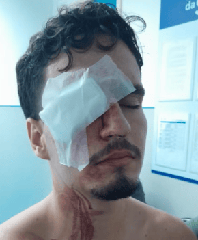 Artur foi atingido por uma bala de borracha no olho direito enquanto saia de Flamengo x Vasco (Foto: Reprodução)