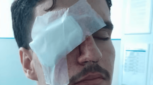Arthur Cortines Laxe, de 18 anos, perdeu a visão do olho direito após ser atingido por uma bala de borracha no entorno do Maracanã ( Foto: Arquivo pessoal)