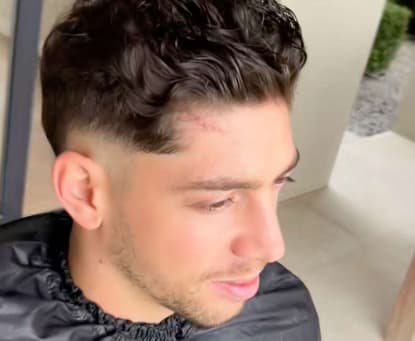 Cicatriz de Valverde após briga com Tchouameni (Imagem: reprodução/X)