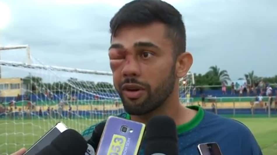 Jogador Humberto, do Piauí, que saiu desfigurado de campo