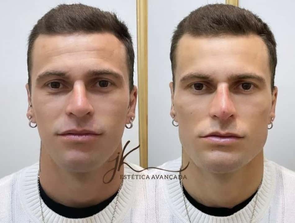Lucas Lima faz harmonização facial e fica 'irreconhecível'; veja o antes e depois