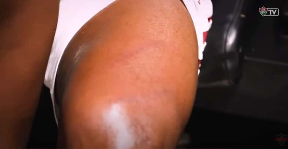 Fluminense mostra marca da trava da chuteira de Rodrigo Caio na coxa de Cazares em bastidores do jogo