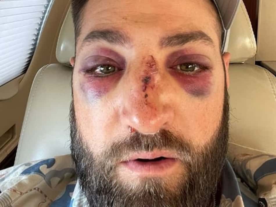 Cenas fortes! Rebatedor da MLB publica imagem impressionante após bolada a 150km/h e fraturas no nariz