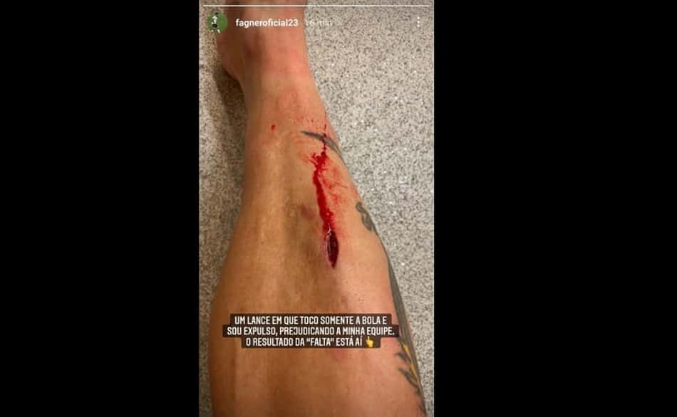 Imagem forte! Fagner mostra corte na perna após expulsão pelo Corinthians: 'Resultado da falta'
