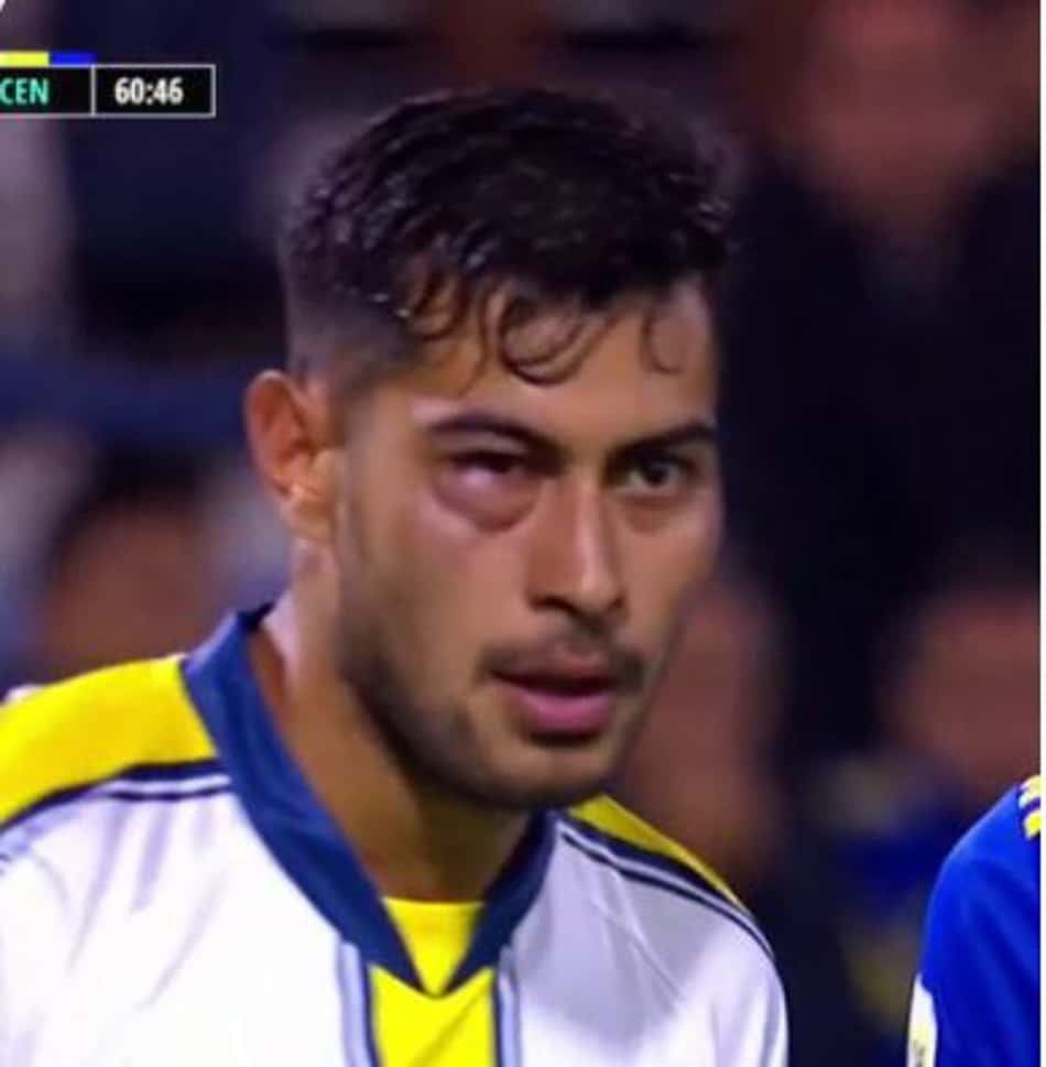 É o Rocky Balboa? Jogador fica com rosto deformado após pancada do adversário
