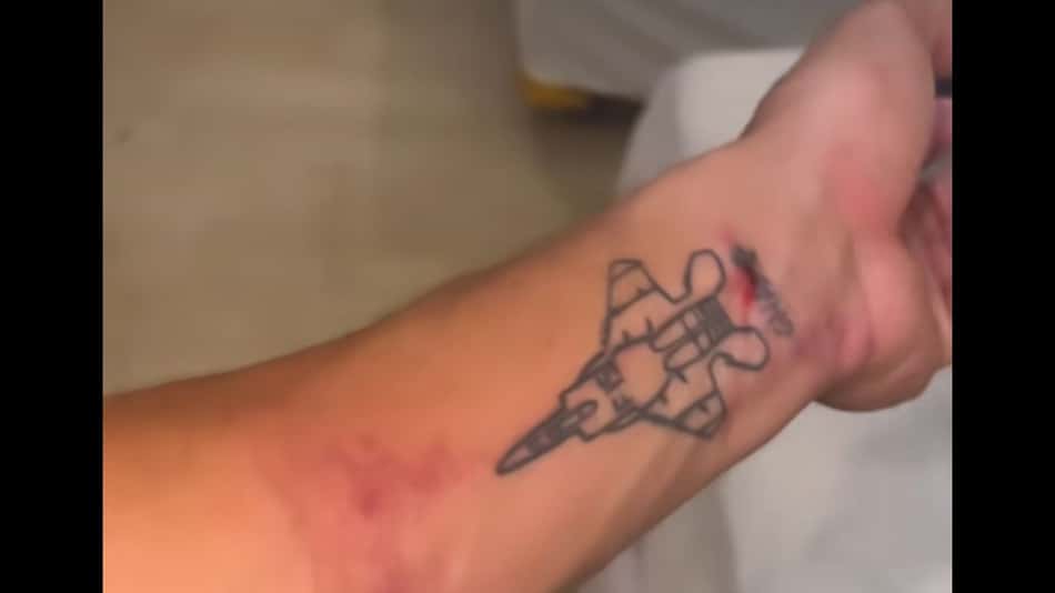 Surfista brasileiro é perseguido por macaco na Indonésia e sofre lesão no braço