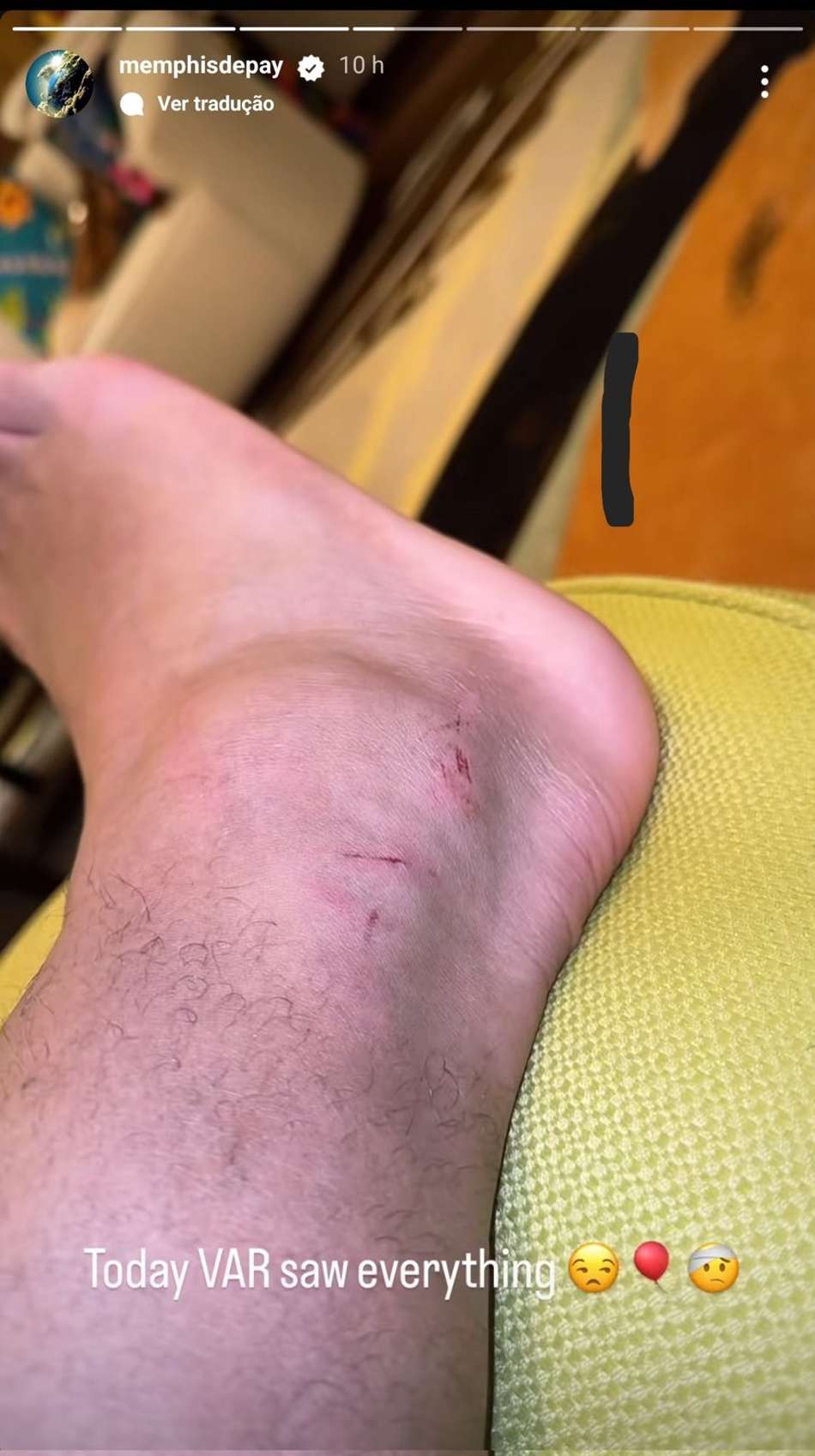Memphis mostrou o estado de seu tornozelo machucado nos stories do Instagram (Foto: Reprodução)