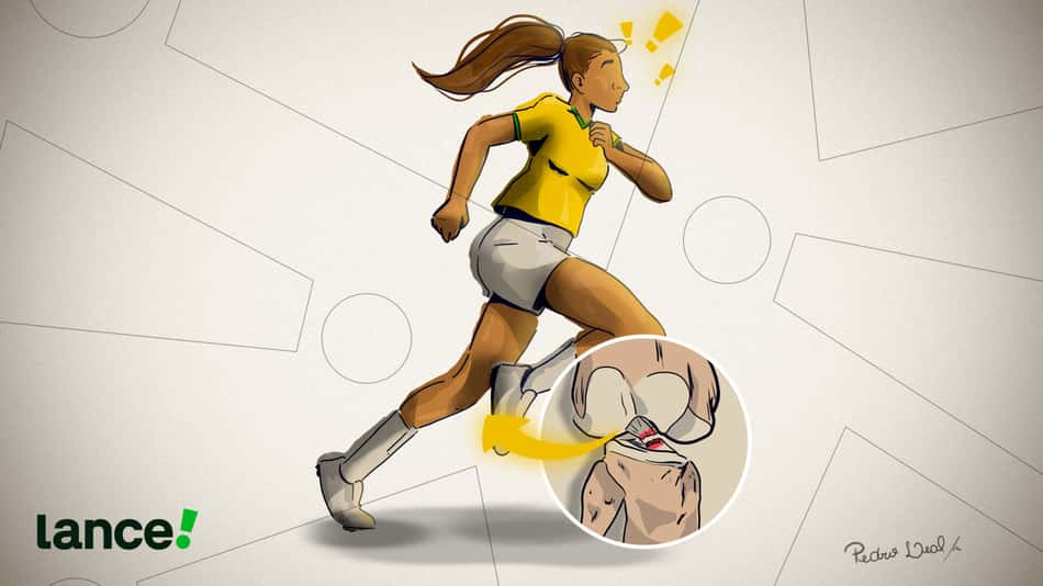 Lesão de Ligamento Cruzado Anterior (LCA). (Ilustração: Pedro Leal)