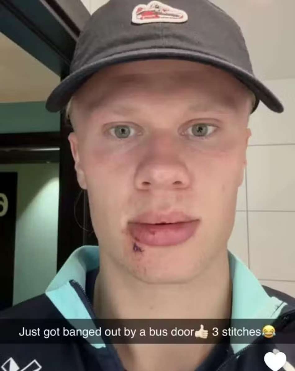 Haaland posta foto de lesão inusitada (Foto: Reprodução/Snapchat)