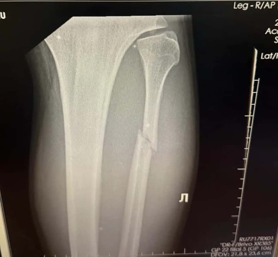 Raio-x de lesão de Valter Walker no UFC 321 (Foto: Reprodução/Instagram: @valterwalkerufc)