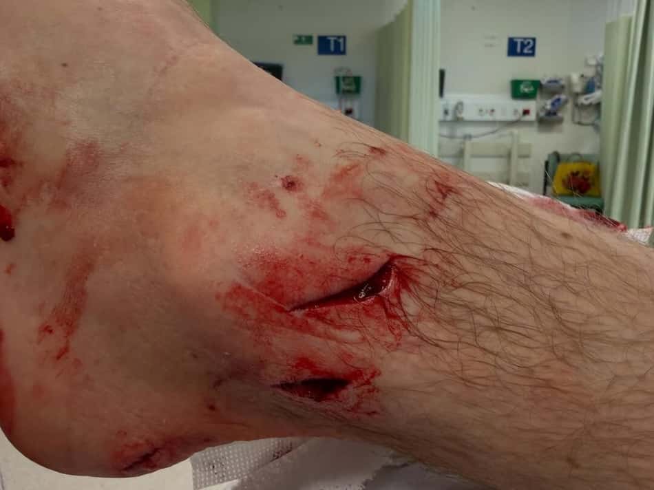 Perna de Ed Sloane, fotógrafo da WSL, após ataque de animal (Foto: Reprodução/Instagram)