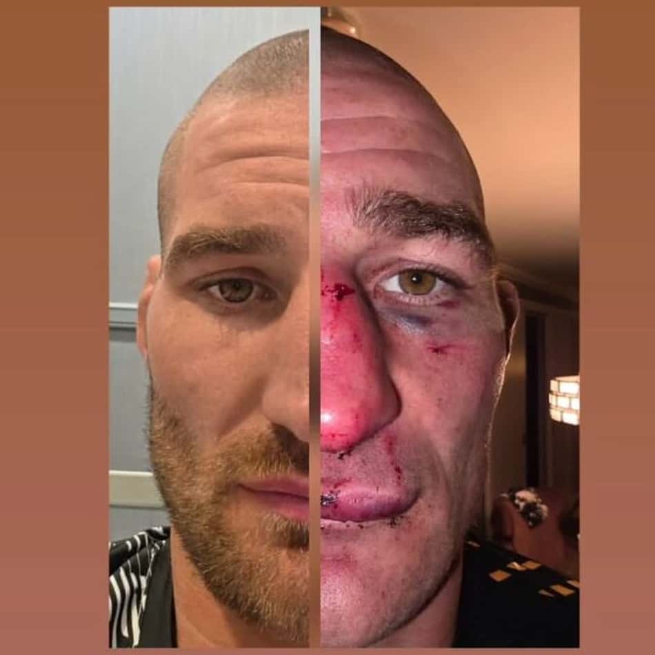Comparação de "antes e depois" do rosto de Sean Strickland após UFC 328 (Foto: Reprodução/Instagram)
