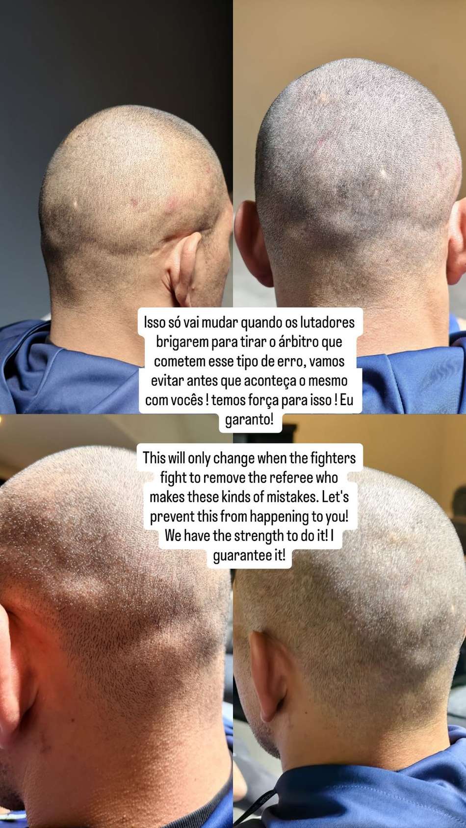 Alex Poatan mostra hematomas na noca após o UFC Casa Branca