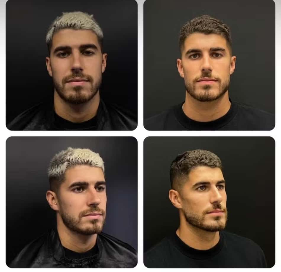 Pedro Raúl, do Corinthians, fez harmonização facial 