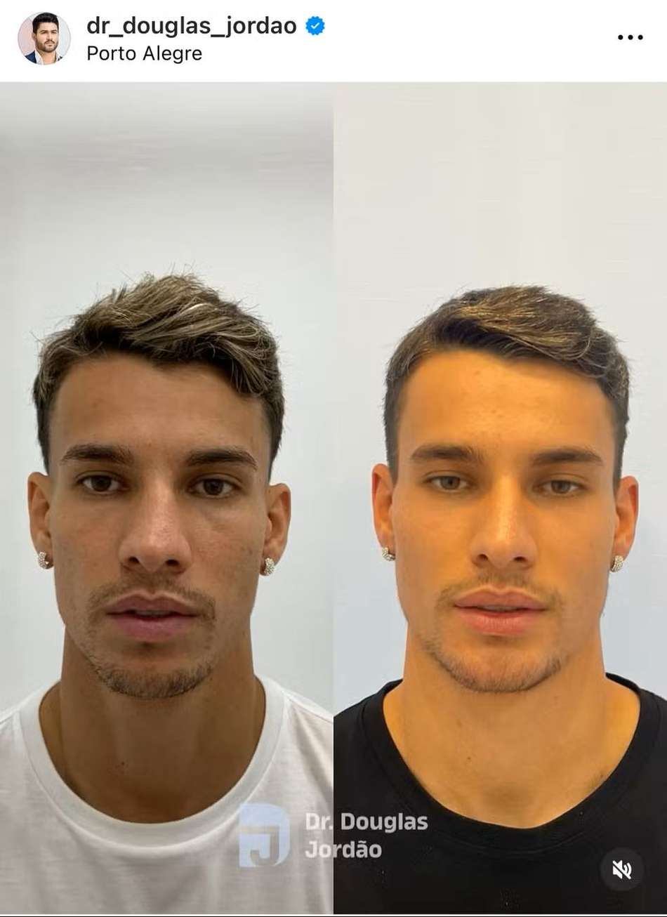 Harmonização Facial de Ferreirinha (Foto: Reprodução)