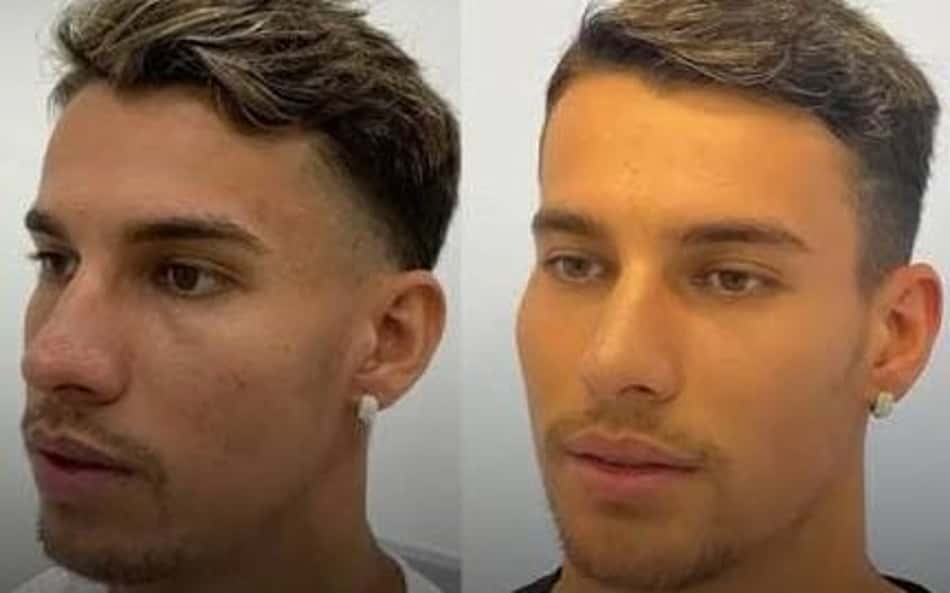 Atletas já divulgaram oficialmente nas redes que realizaram procedimentos (Foto: Reprodução)