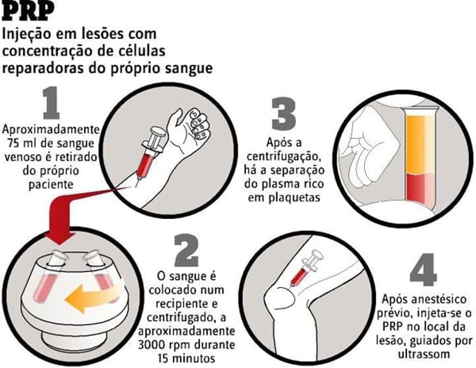 Infográfico - Tratamento PRP (Foto: Reprodução)