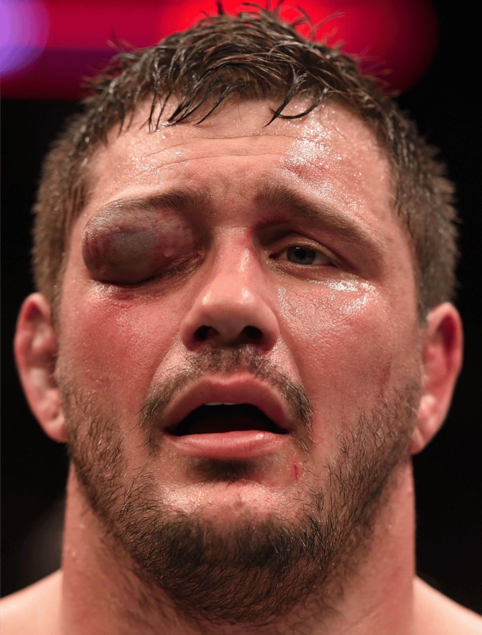 Peso-pesado do UFC sai do octógono com inchaço bizarro após nocaute