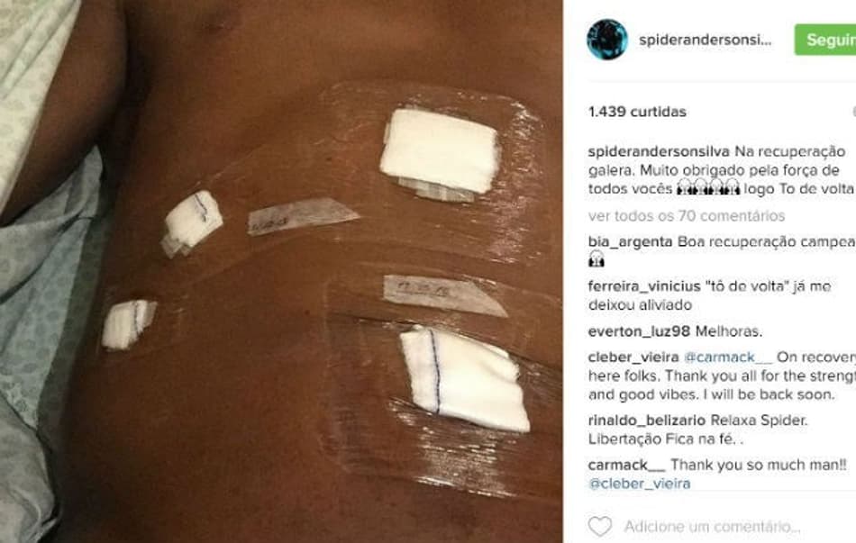 Anderson Silva posta foto do pós-operatório e promete retorno breve