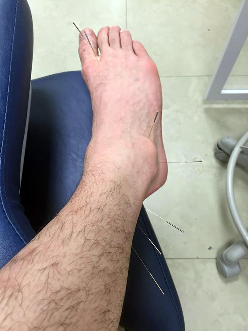 Diego Hypolito faz tratamento no pé direito