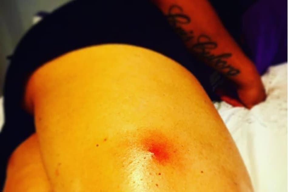 Cris Cyborg deixa o hospital após ser picada por aranha 'viúva negra'