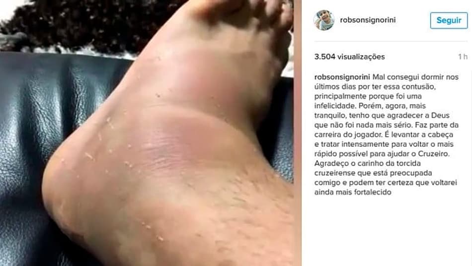 Robinho lamenta lesão e posta foto do tornozelo inchado