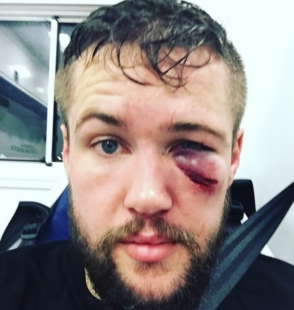 Lutador posta foto com fratura no rosto após UFC Hamburgo