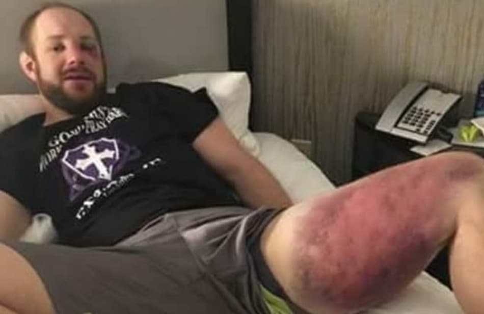 Vítima de brasileiro mostra hematoma assustador após combate