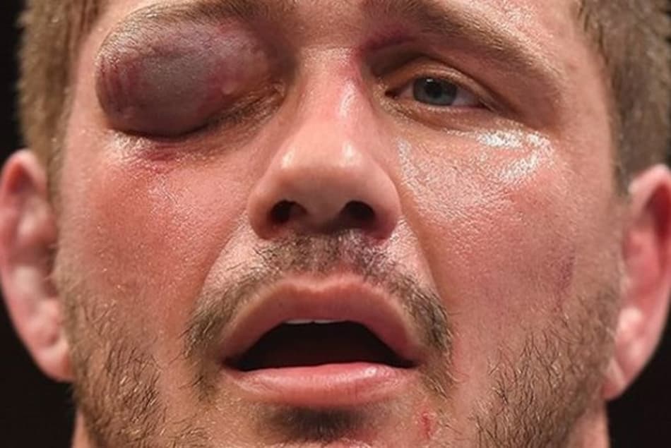 Matt Mitrione ficou com o olho inchado após derrota contra Travis Browne no UFC