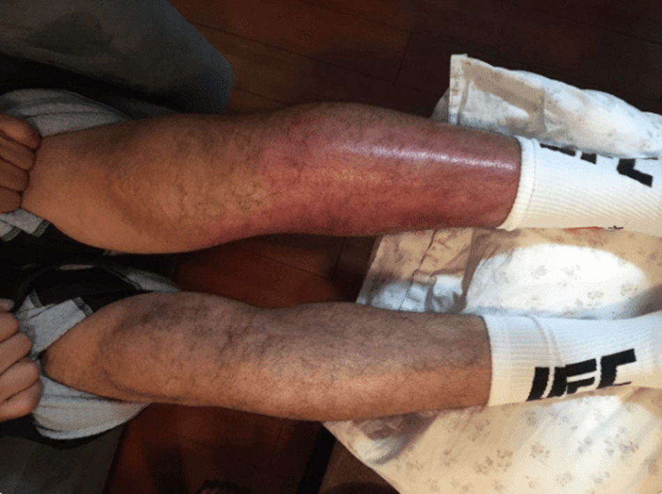 Após derrota no UFC, lutador mostra lesão assustadora. Veja a foto!