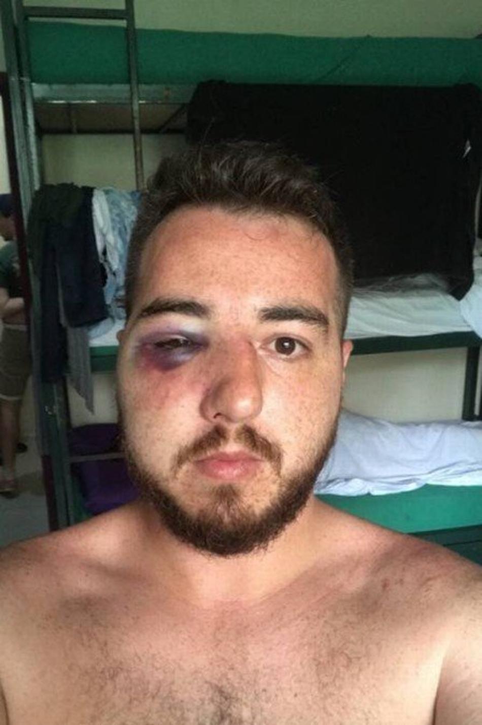Torcedor do Independiente mostra olho roxo e acusa torcedores do Fla de emboscada